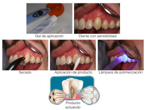 Sensibilidad Dentaria.001